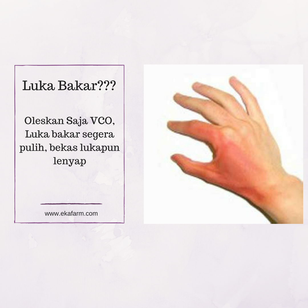 VCO untuk Luka Bakar