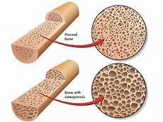 VCO Untuk Osteoporosis