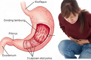 Penawar Sakit Maag Berbahan Alami Paling Ampuh