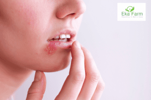 Herpes – Gejala Penyebab dan Cara mengobatinya