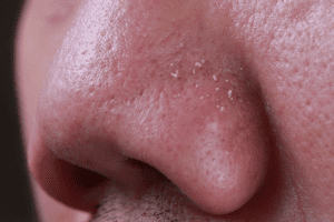 10 Cara Menghilangkan Komedo Di Hidung Dengan Bahan Alami