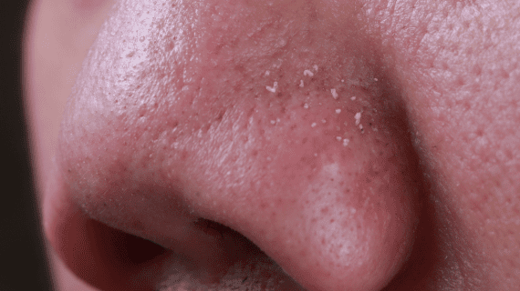 10 Cara Menghilangkan Komedo Di Hidung Dengan Bahan Alami