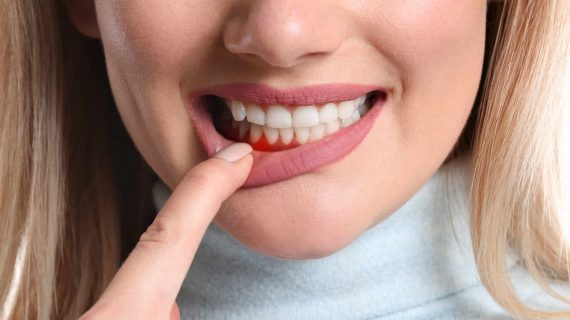 Produk Rumahan yang Mujarab untuk Menghilangkan Sariawan dalam 3 Hari