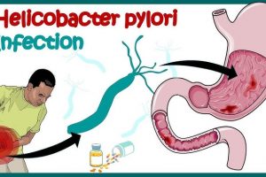 Bakteri Helicobacter Pylori Penyakit Apa? Cari Tahu Disini!