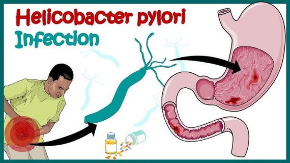 Bakteri Helicobacter Pylori Penyakit Apa? Cari Tahu Disini!
