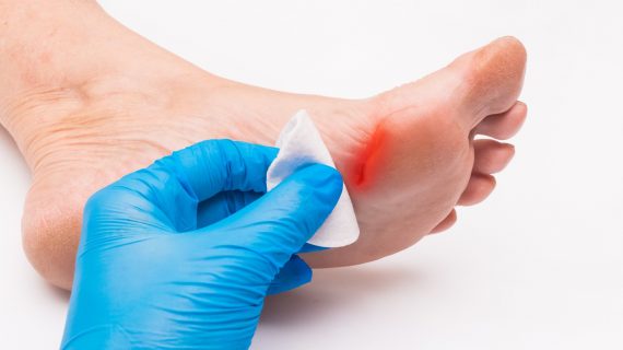 Komplikasi Diabetes Melitus Tipe 2 dan Cara Mencegahnya