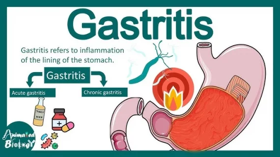 Gastritis adalah Penyakit yang Sering Diabaikan, Tapi Bisa Berbahaya